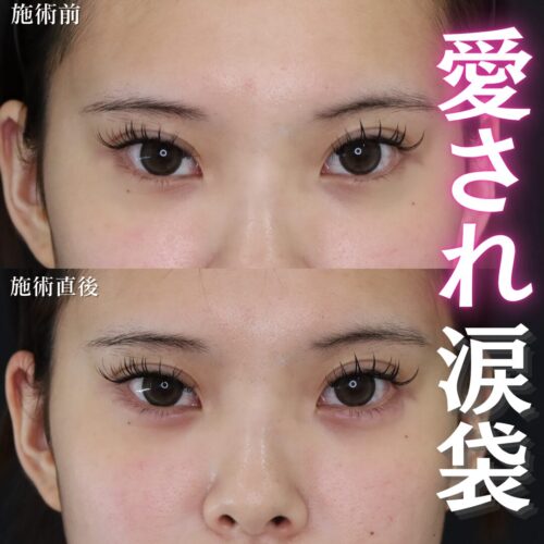 涙袋　ヒアルロン酸注入　症例